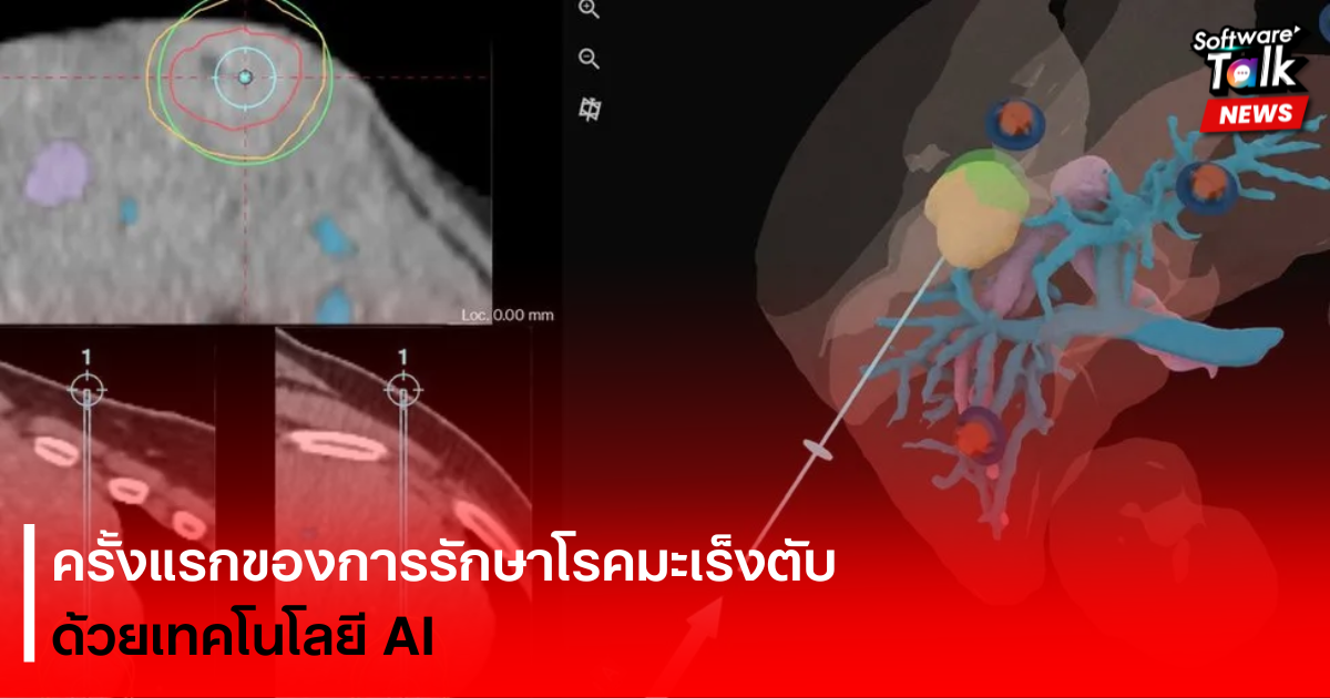 ครั้งแรกของการรักษาโรคมะเร็งตับด้วยเทคโนโลยี AI